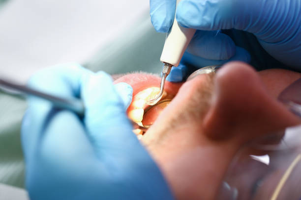 Best Emergency Dental Care for Broken or Chipped Teeth in Ord, NE